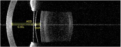 Comparison of Vault Measurements Using a Swept-Source OCT-Based Optical Biometer and Anterior Segment OCT